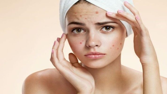 dile-adios-al-acne-con-estos-sencillos-y-practicos-remedios-caseros