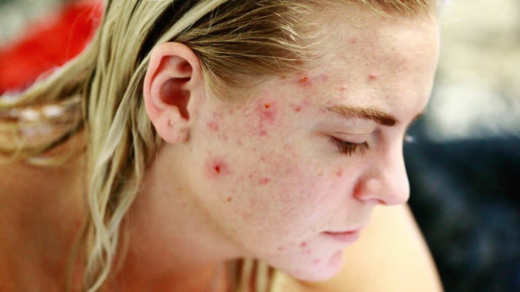 El acné es uno de los primeros síntomas de problemas hormonales. 