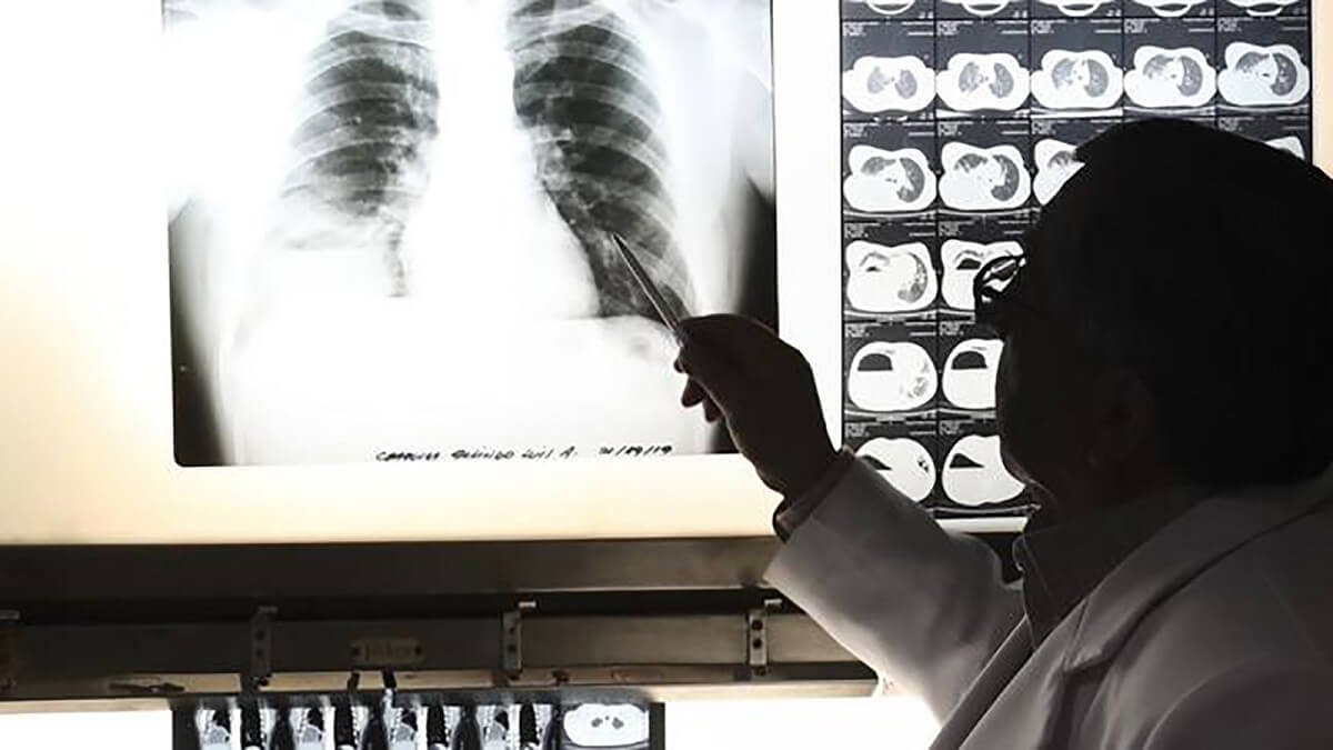La tuberculosis asociada al padecimiento de COVID-19 pone en más riesgo la vida del personal sanitario. Foto referencial