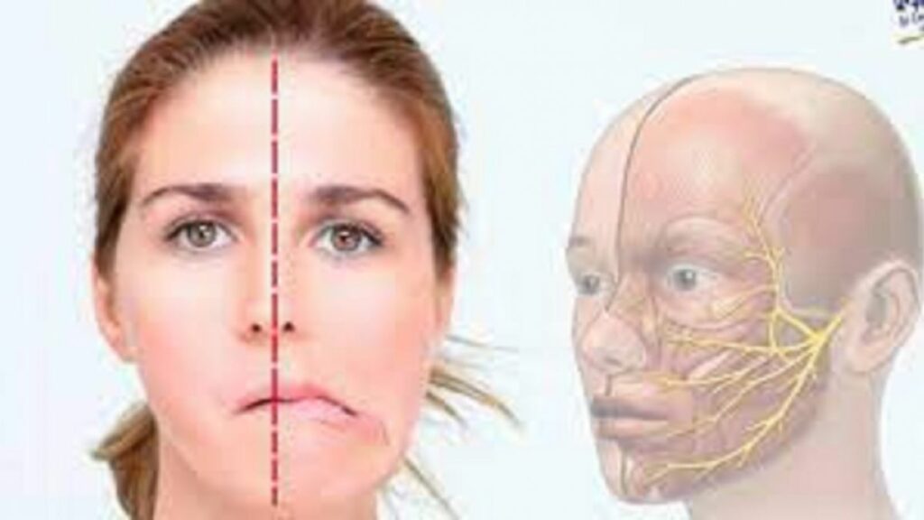 Las personas que padecen de diabetes tienen mayor posibilidad de sufrir una parálisis facial. 