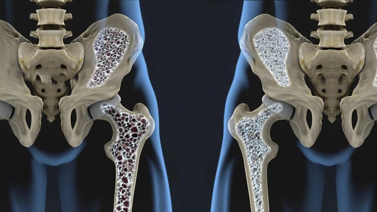 La osteoporosis es la epidemia silenciosa.