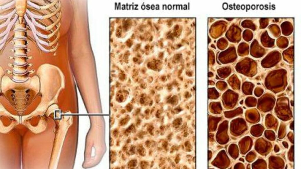 Así se presenta la osteoporosis. 