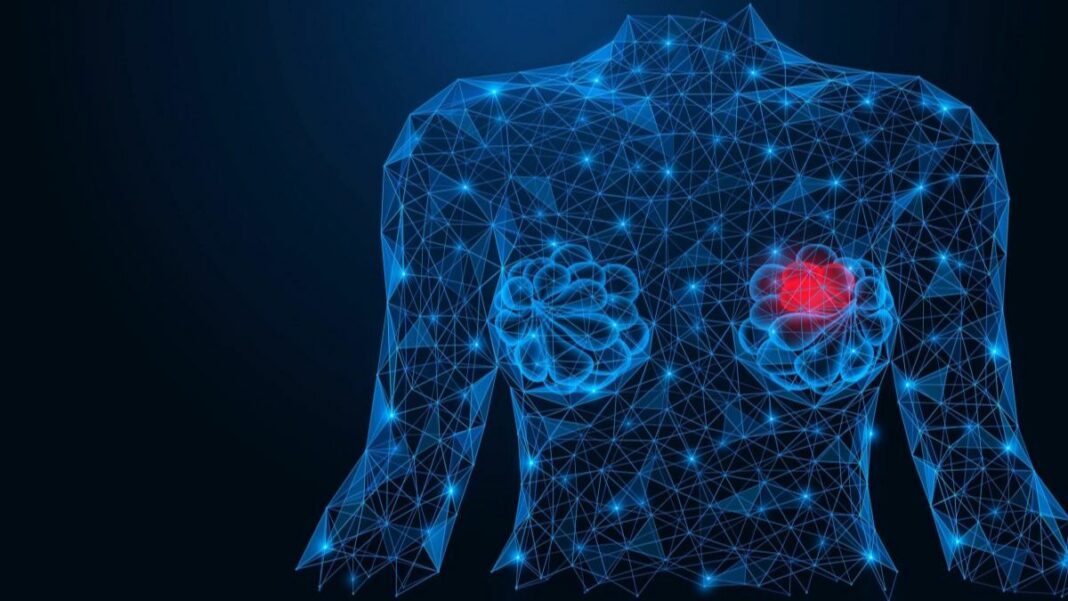 La IA puede haber diagnosticado en exceso ciertas formas de cáncer de mama temprano, llamado carcinoma ductal in situ.
